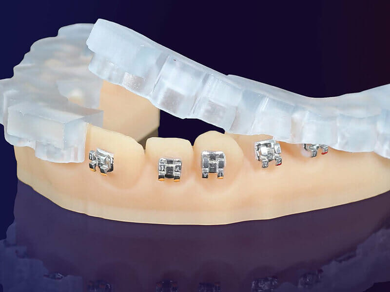 KeyOrtho IBT Dental Material