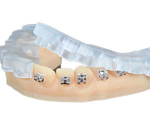 Indirect Bonding Trays